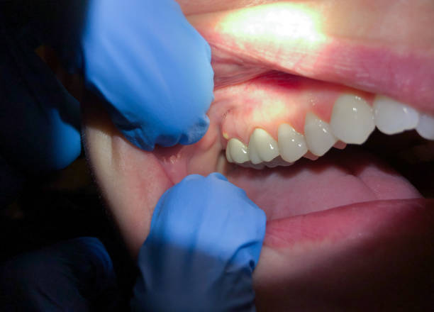 Best Broken or Cracked Tooth Emergency Dentist in Orofino, ID